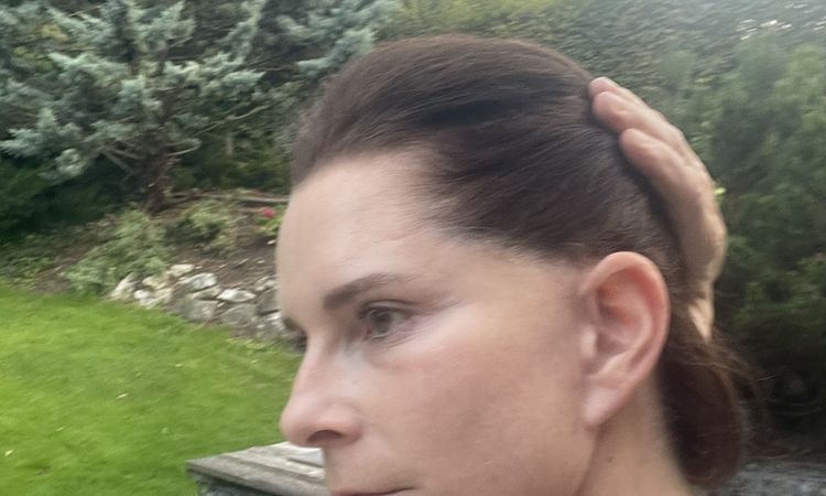 Abstehende ohren und fehlender haaransatz nach hals facelift - 82505