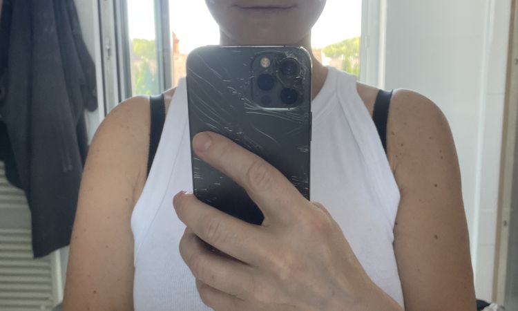 Abstehende ohren und fehlender haaransatz nach hals facelift - 82506