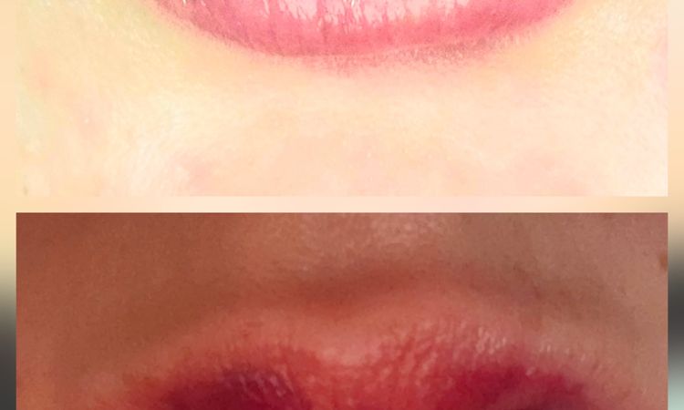 Lippen aufspritzen, alles weg - 82536