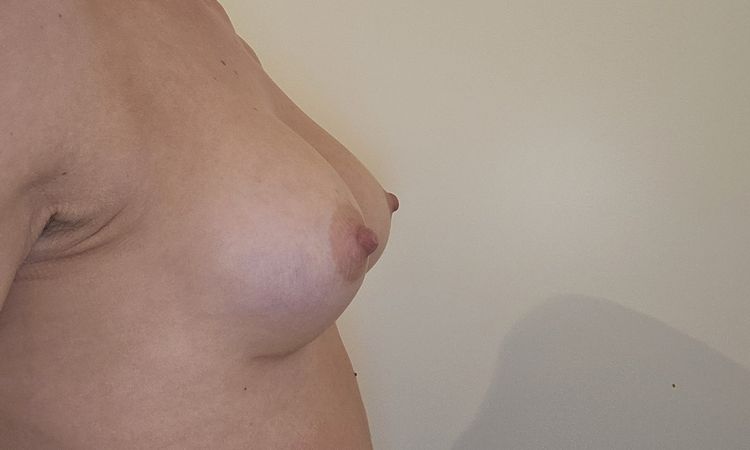 Implantate passend/ zu hoch? - 82542