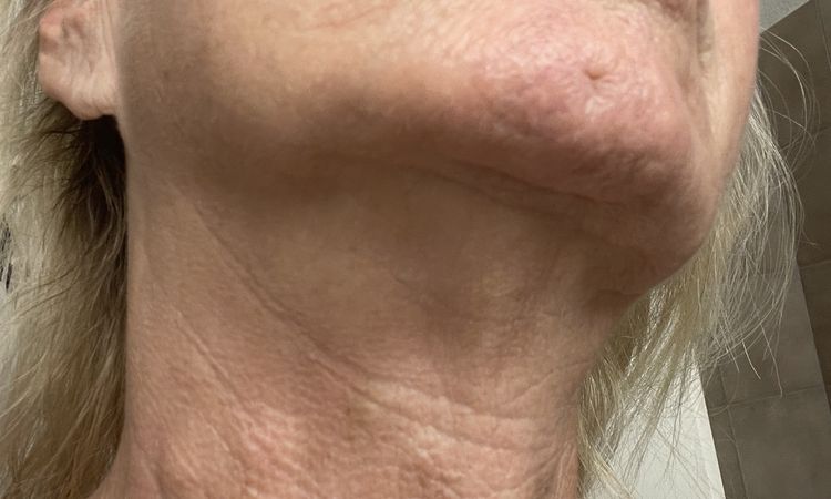 Knotenbildung im Hals nach Lanluma injizierung am 25.06.25 - 82560