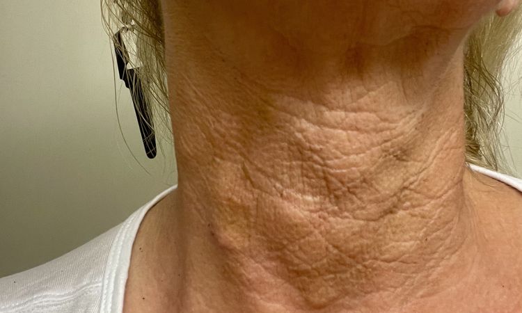 Knotenbildung im Hals nach Lanluma injizierung am 25.06.25 - 82561