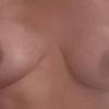 Warum unterschiedliche Brüste nach Implantatwechsel!?