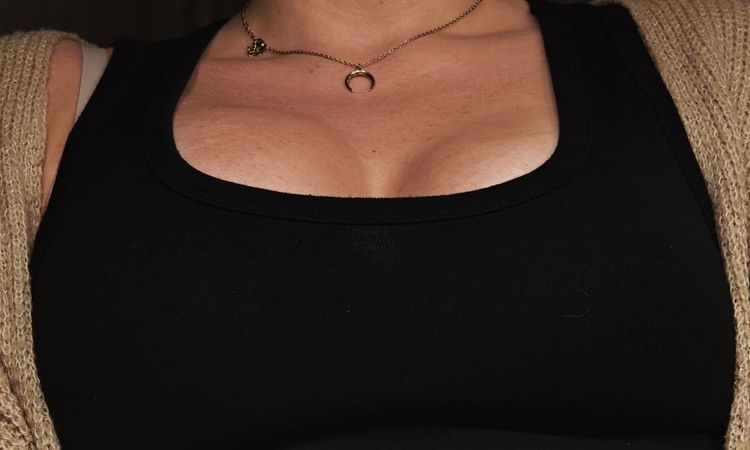 Fehlendes Volumen nach Bruststraffung mit Implantaten - 82587