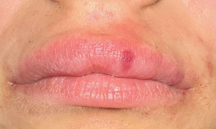 Asymmetrie der Lippen - 82599