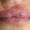 Asymmetrie der Lippen