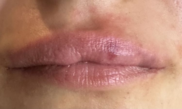Asymmetrie der Lippen - 82600