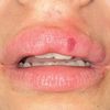Asymmetrie der Lippen