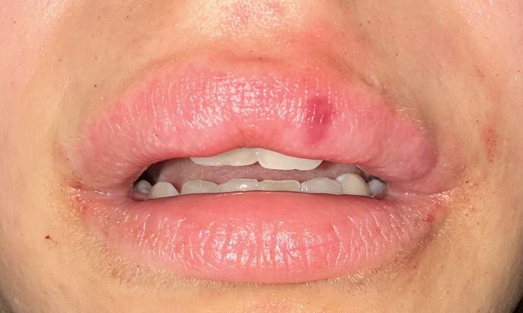 Asymmetrie der Lippen - 82601