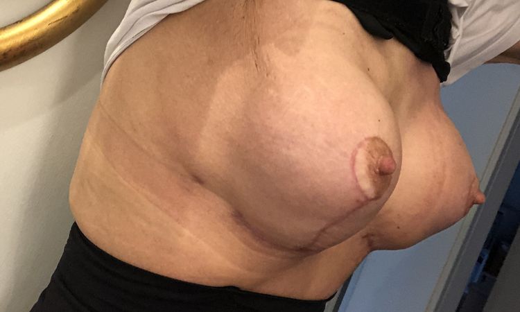 Bruststraffung mit Vergrößerung - 82611