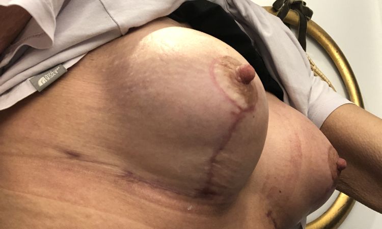 Bruststraffung mit Vergrößerung - 82613