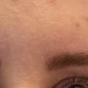 Gliding Brow Lift Augenbrauen Lähmung