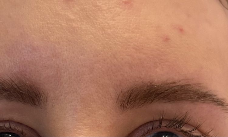 Gliding Brow Lift Augenbrauen Lähmung - 82651