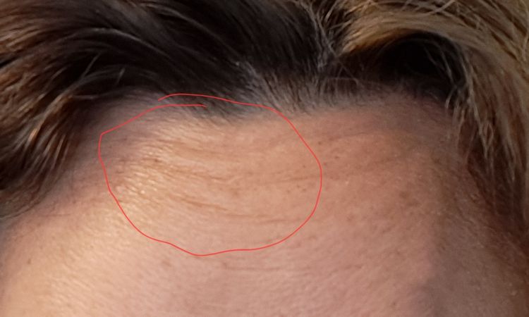 Botox 2 x nachkorrigieren - 82665