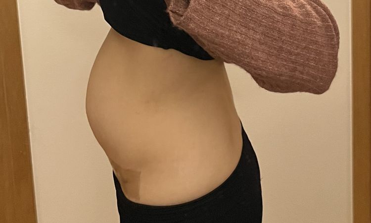 Kugelbauch nach Mini-Bauchdeckenstraffung - 82687