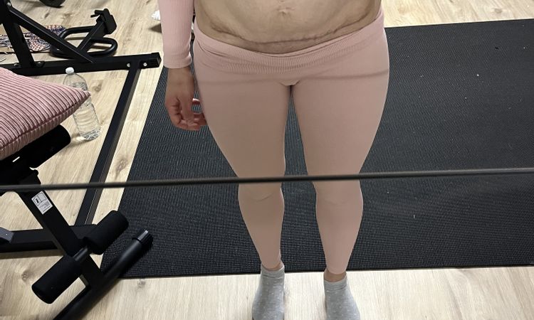 Kugelbauch nach Mini-Bauchdeckenstraffung - 82688