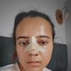 Schweinenase nach OP