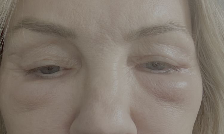 Extreme Schwellung nach Eigenfetttranfer unter Auge - 82694