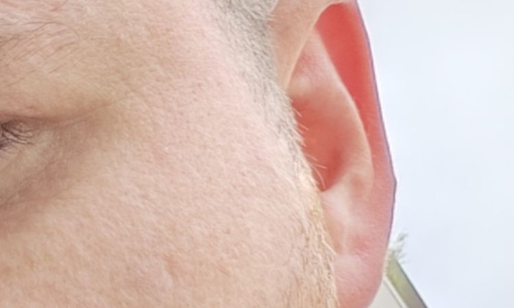 Kann man diese Narbe unkenntlich machen? - 82701
