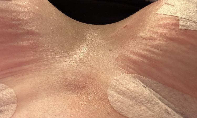 Faltige Haut nach Bruststraffung/Verkleinerung mit Implantat - 82704