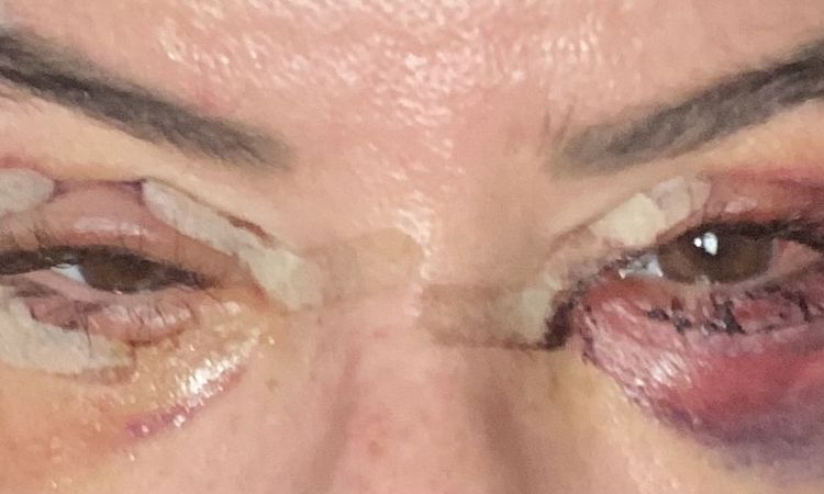 Ist der Heilungsverlauf am 3.Tag Post op Ober und Unterlidstraffung normal? - 82725