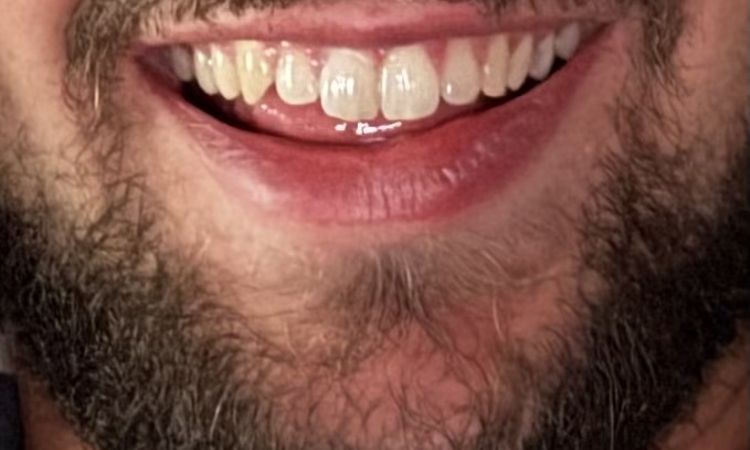 Ausgeprägtes schiefes Lächeln - 82742