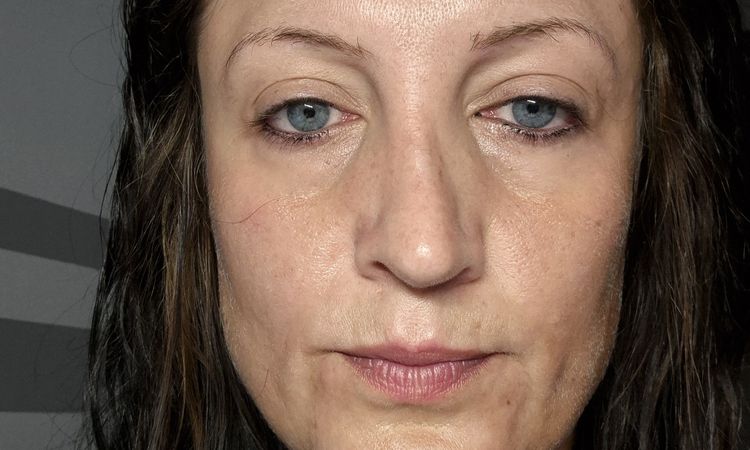 Nach Nasen OP extrem asymmetrische Schwellung - 82753