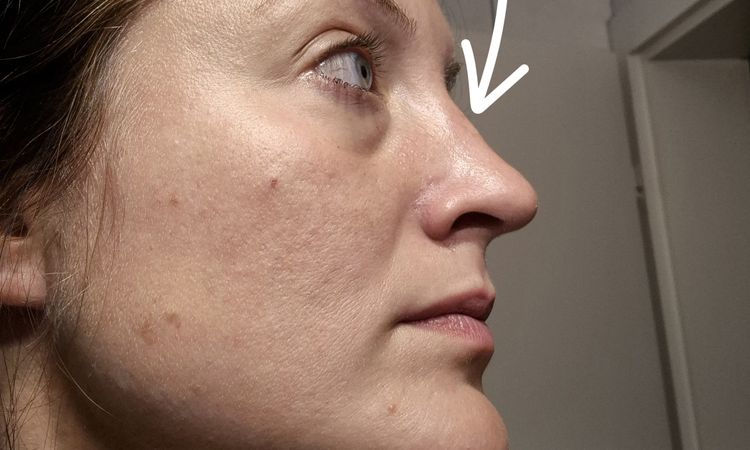 Nach Nasen OP extrem asymmetrische Schwellung - 82754