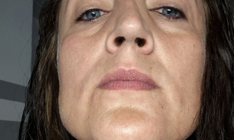 Nach Nasen OP extrem asymmetrische Schwellung - 82755