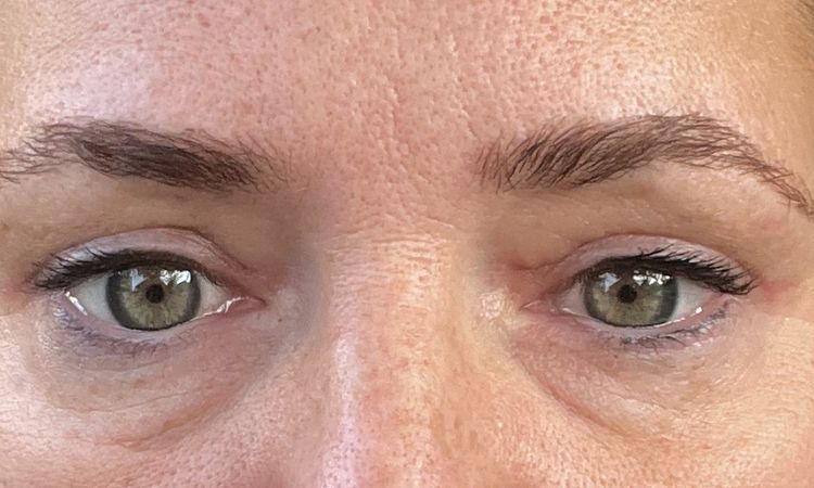 Asymmetrie nach Oberlidstraffung und anheben der Brauen - 82756