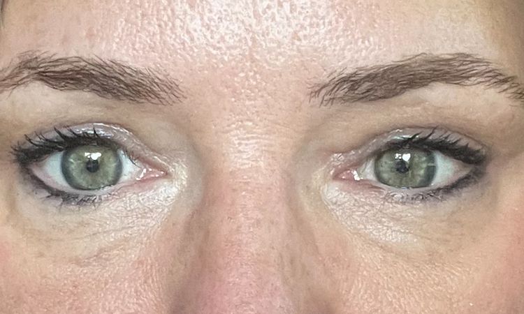 Asymmetrie nach Oberlidstraffung und anheben der Brauen - 82757