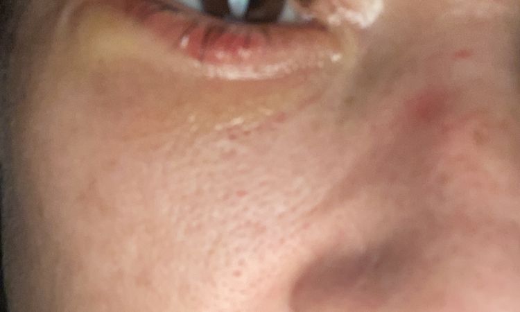 Ist der Heilungsverlauf nach Ober und Unterlidstraffung normal? - 82762