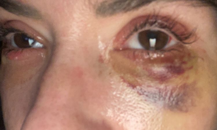 Ist der Heilungsverlauf nach Ober und Unterlidstraffung normal? - 82763