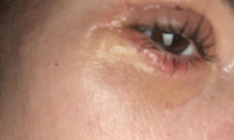 Ist der Heilungsverlauf nach Ober und Unterlidstraffung normal? - 82764