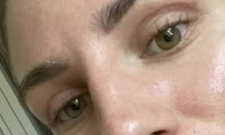 Oberlidstraffung Korrektur nötig ? - 82767