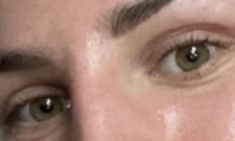 Oberlidstraffung Korrektur nötig ? - 82768