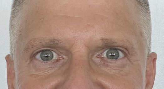 Resultat nach Lidstraffung - 82851