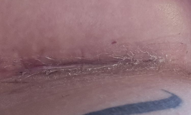 BV Pflaster entfernen - sieht es gut aus? - 82853