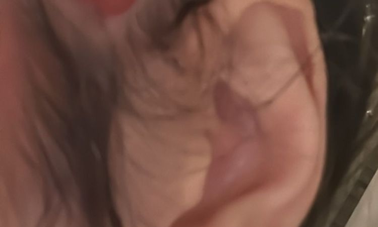 Offene Wunde 4 Monate nach Schläfenlift - 82869