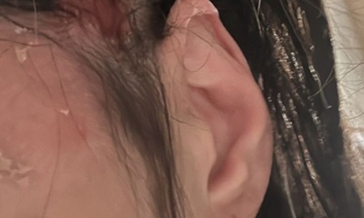 Offene Wunde 4 Monate nach Schläfenlift - 82870