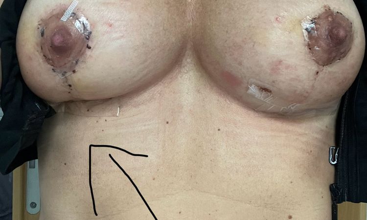 15 Tage Post OP Implantate und Straffung - 82882