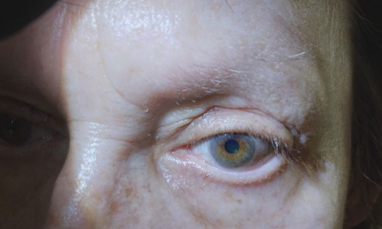 Schlupflid OP dicke Beulen - 82890