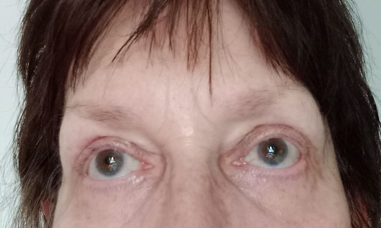 Frage zu meiner Oberlid-Straffung. Zu viel Haut? - 82899