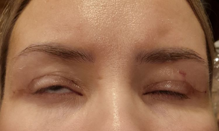 Oberlidstraffung – unvollständiger Lidschluss - 82903