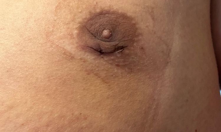 Gynäkomastie OP -Heilungsverlauf - 82925