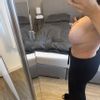 Waterfall Deformity nach Implantatswechsel mit Straffung