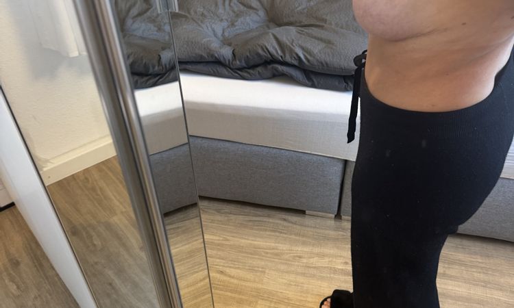 Waterfall Deformity nach Implantatswechsel mit Straffung - 82927
