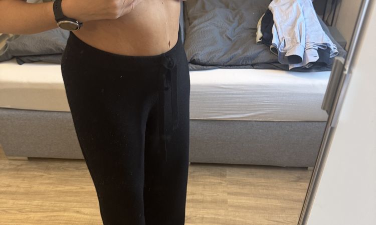 Waterfall Deformity nach Implantatswechsel mit Straffung - 82929