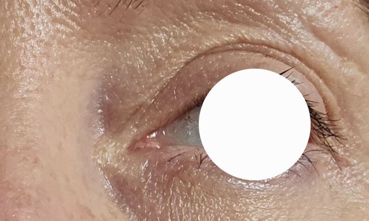 Erneute Oberlidstraffung - 82931