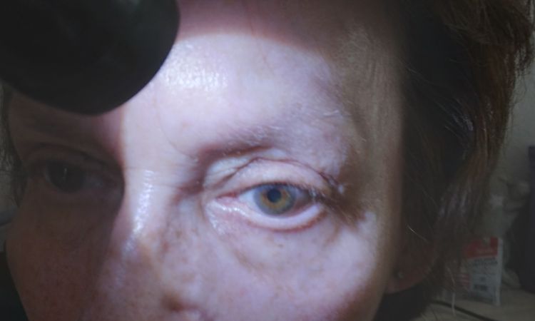 Wülste am Auge 3 Monate nach OP - 82957